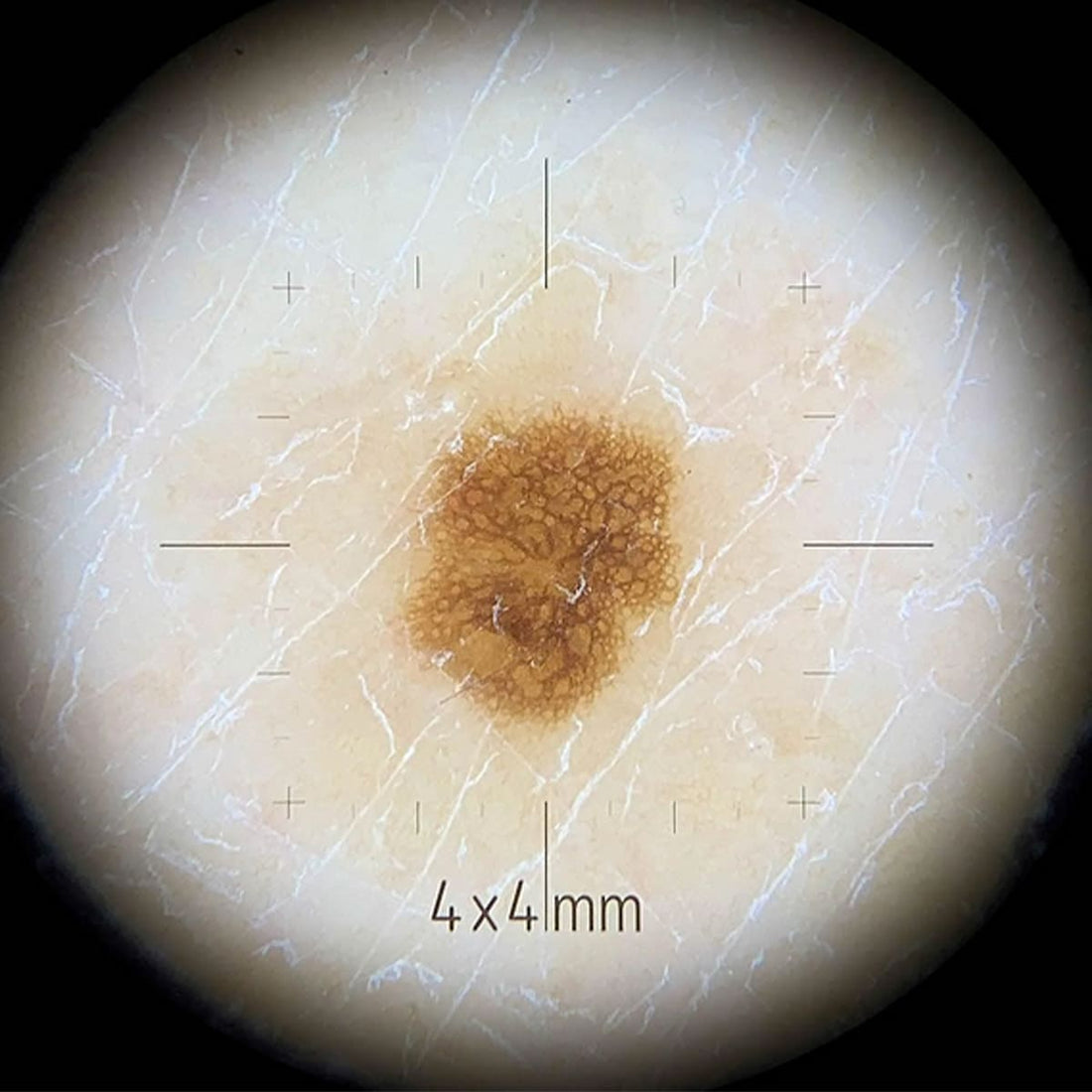 Rondelle de Contact DermLite Petite pour Dermatoscopes DL4 - Précision et Confort