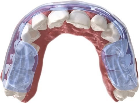 AQUALIZER Gouttière Dentition Mini 1.5mm Medium Confort | Protection Nocturne